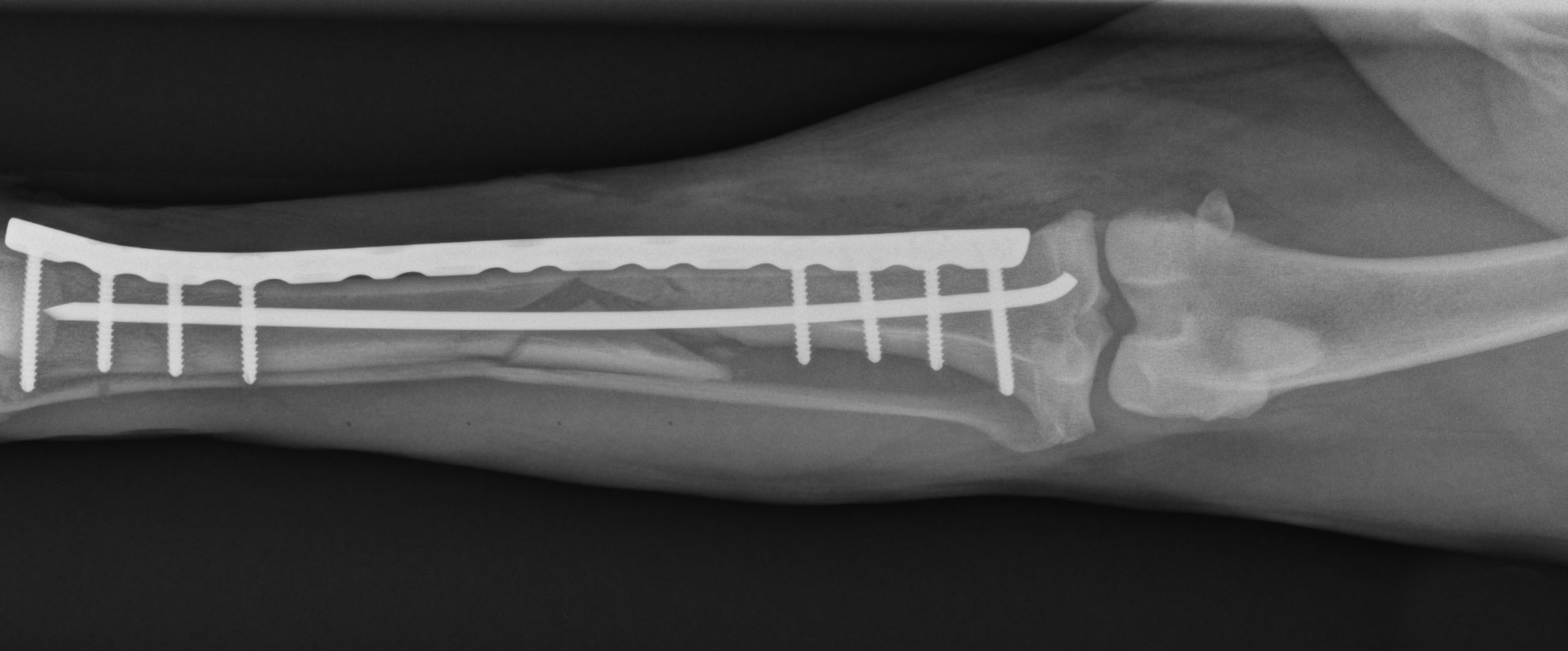 X-ray with PAX plate on bone